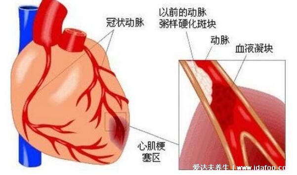 心肌梗塞的前兆和表现，四大症状牙疼也可能是心梗前兆