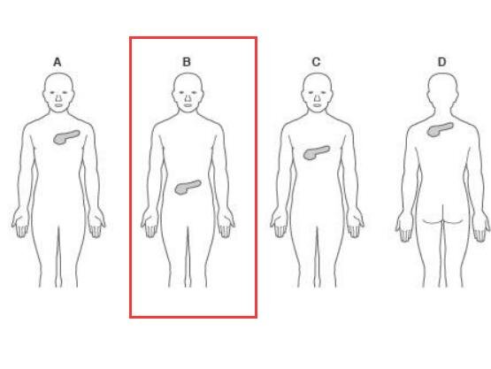 胰腺在人体的哪个部位图解，位于人体上腹部疼痛感会沿着致全身