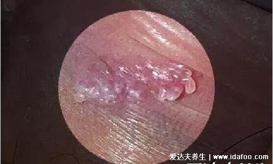 男女尖疣湿早期症状图片，从米粒大的丘疹长成菜花样的疙瘩