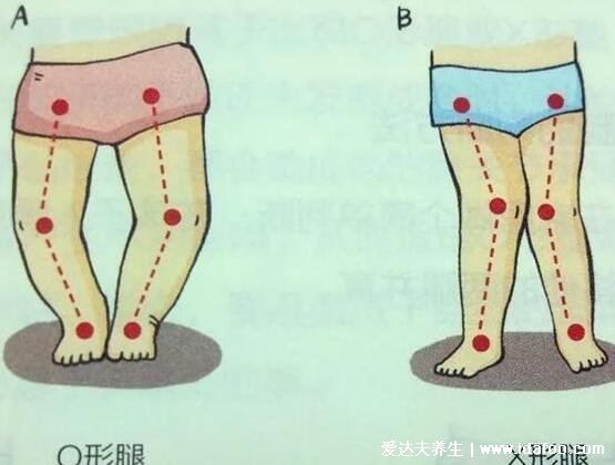 罗圈腿图片症状及矫正方法，呈膝盖外翻可通过运动改善