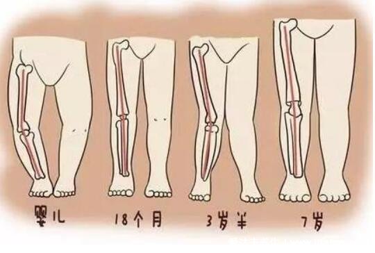 罗圈腿图片症状及矫正方法，呈膝盖外翻可通过运动改善