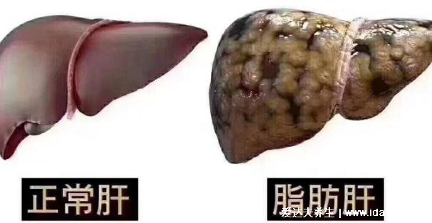 脂肪肝最怕三种食物，经常吃还可以远离高血脂