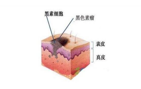 黑色素瘤早期症状图片，通过abcd法轻松辨别普通痣和黑色素瘤