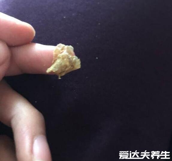 感染后的白色念珠菌图片，呈豆渣样分泌物不及时治疗会蔓延全身