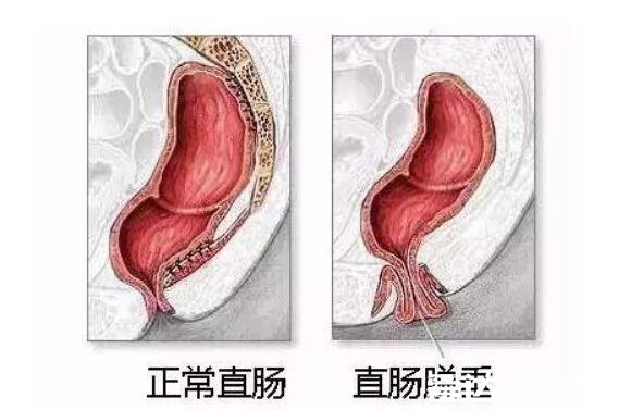 肛门处长了一个肉疙瘩是怎么回事，可能是比痔疮更严重的X病