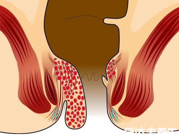 肛门处长了一个肉疙瘩是怎么回事，可能是比痔疮更严重的X病