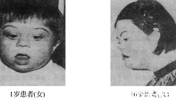 超雌综合症患者特别漂亮是其次，还伴随智力不全无法生育