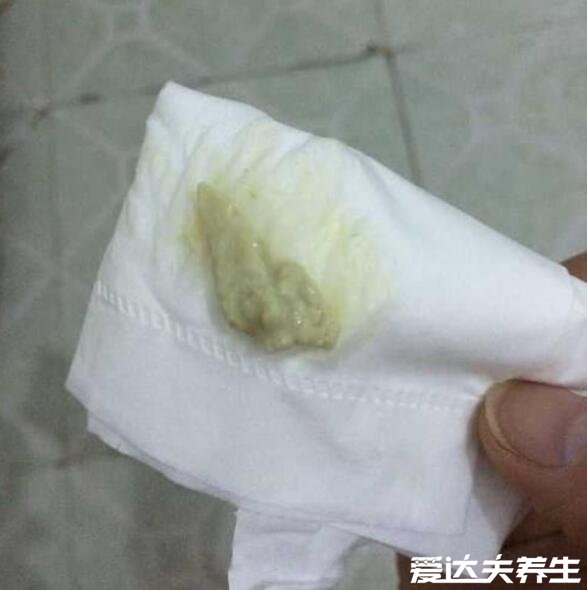 霉菌用手抠出来的图片，呈豆腐渣样分泌物(手抠会加重炎症)