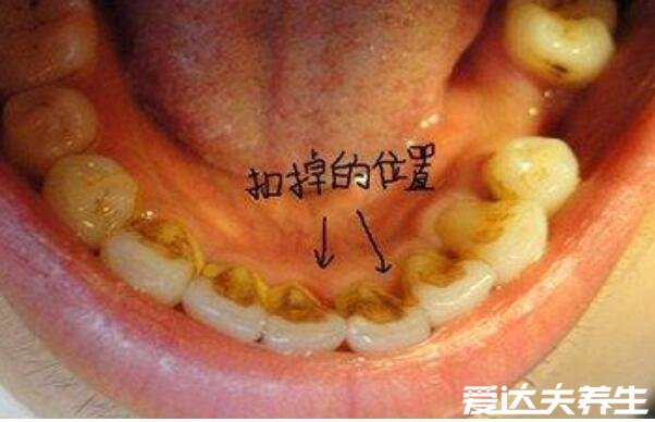 牙结石可以自己抠掉吗，不要自己扣定期洗牙才是最安全的