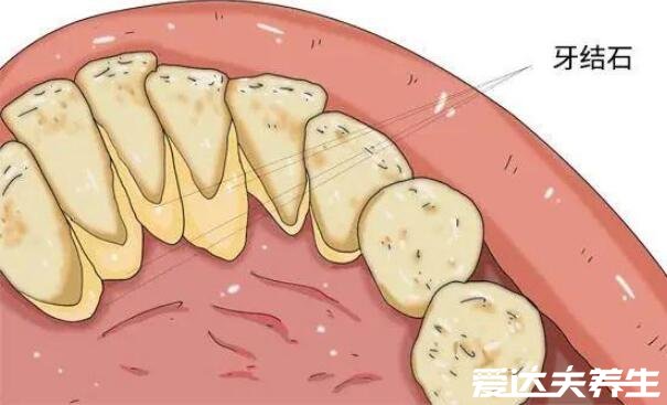 牙结石可以自己抠掉吗，不要自己扣定期洗牙才是最安全的