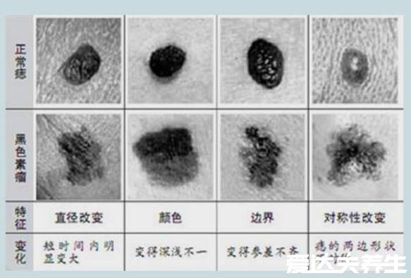 黑色素瘤早期症状图片，和普通黑痣相似但又有五点不同