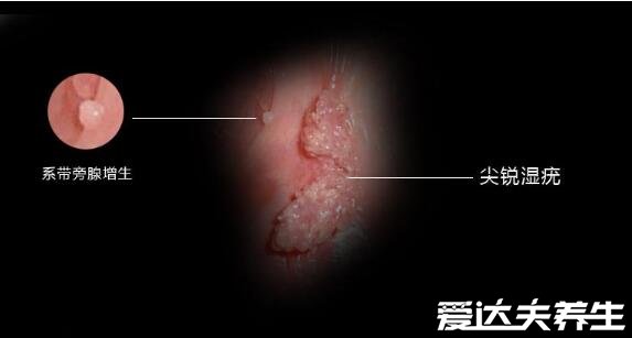尖湿锐尤典型图片，尖锐湿疣早期症状真假辨别