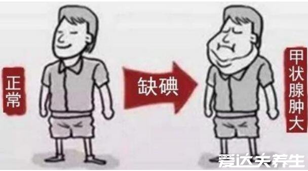 真实大脖子病图片，警惕早期症状颈部变粗有明显甲状腺肿大