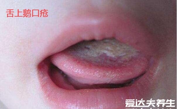 婴儿鹅口疮最早期图片，口腔内有白色的乳状物和奶苔很像