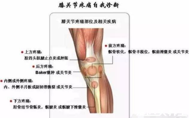 膝盖各个部位疼痛图解，不同位置疼痛代表不同疾病(两侧疼最严重)