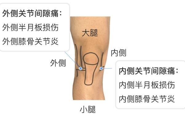 膝盖各个部位疼痛图解，不同位置疼痛代表不同疾病(两侧疼最严重)