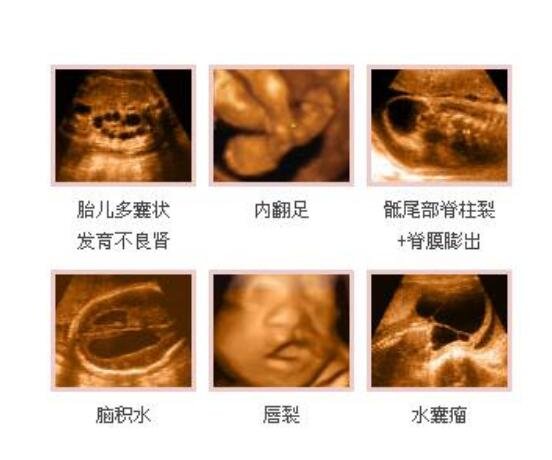 四维彩超多少钱，300-500元不等且安全无害(图片)