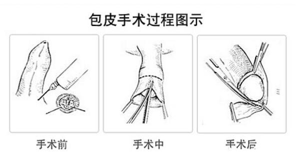 小儿包茎症状图片，不同程度包皮包茎的危害一定要了解