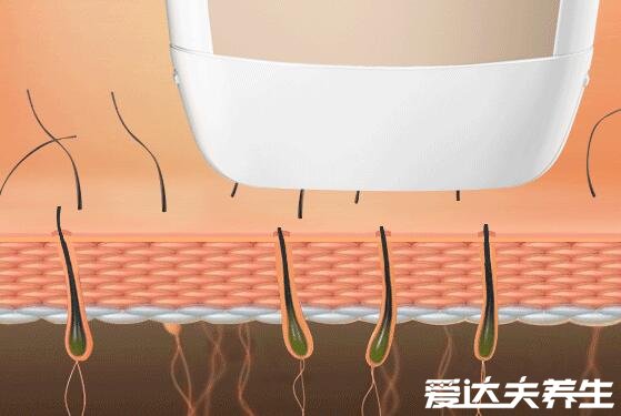 激光脱毛6年后后悔了，原来并不是永久性去除毛发(有反弹风险)