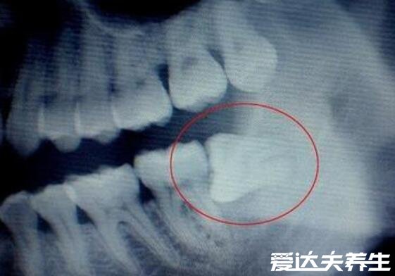 拔智齿后遗症太多了不准确，正确拔牙可避免发炎预防蛀牙