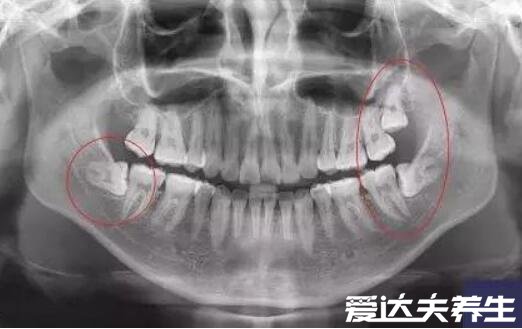 拔智齿后遗症太多了不准确，正确拔牙可避免发炎预防蛀牙