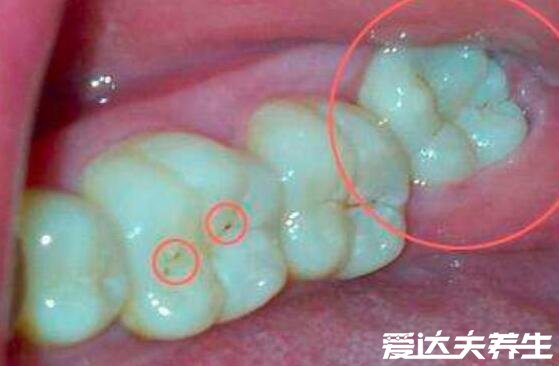 拔智齿后遗症太多了不准确，正确拔牙可避免发炎预防蛀牙