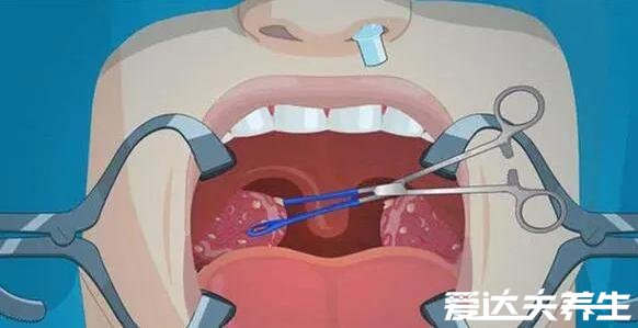 切除腺样体后悔到家了，会导致孩子免疫力下降还容易病症复发