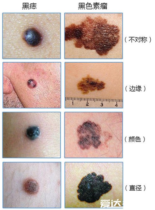 容易癌变的痣的图片，可根据4个特征来进行早期基础判断