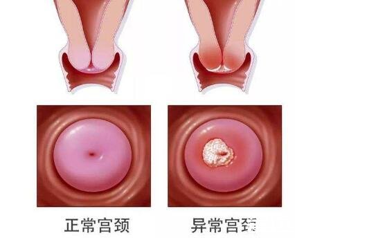 hpv阳性是什么意思，人乳头瘤病毒(hpv)不一定是性传播