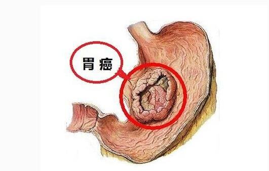 胃癌前期五个身体信号，食欲减退快速消瘦是前兆