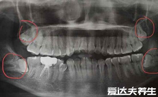 最难拔的智齿图，横生牙齿要锯开骨头还影响神经