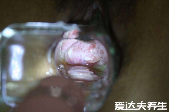 感染女性hpv真实图片，80%人会感染hpv但没必要惊慌