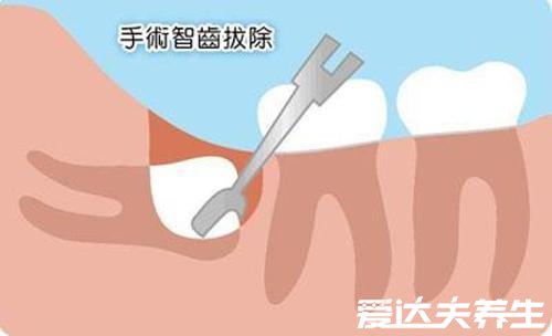 史上最难拔的智齿图，倒长在肉里需要切骨取出缝针愈合