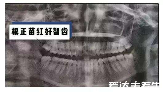 史上最难拔的智齿图，倒长在肉里需要切骨取出缝针愈合