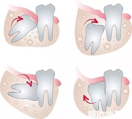 史上最难拔的智齿图，倒长在肉里需要切骨取出缝针愈合