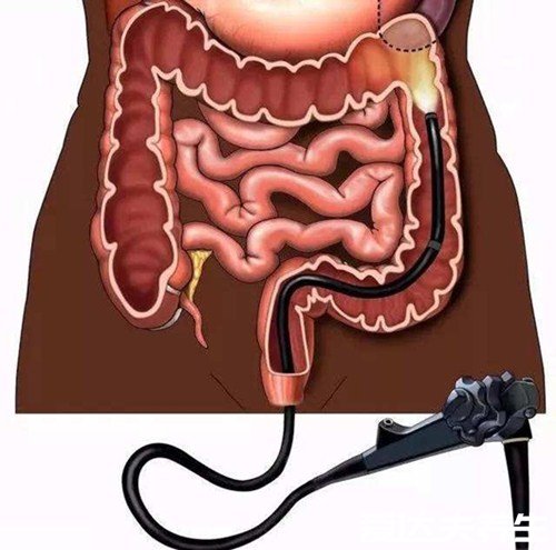 过来人为什么不建议年轻人做肠镜，只因胃镜检查太疼(可做无痛)