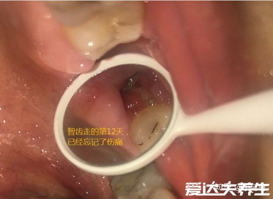 超详细拔牙后窟窿恢复图，保持口腔卫生3个月就能完全恢复