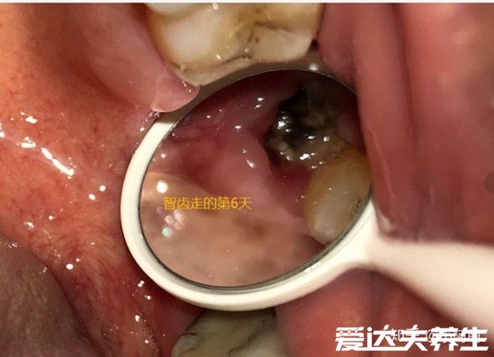 超详细拔牙后窟窿恢复图，保持口腔卫生3个月就能完全恢复