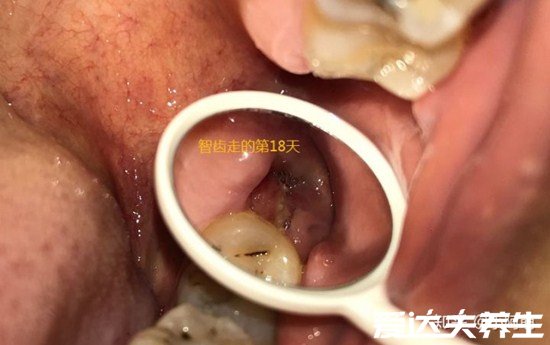 超详细拔牙后窟窿恢复图，保持口腔卫生3个月就能完全恢复