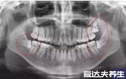 如何判断自己长智齿了，揪出智齿的四种方法