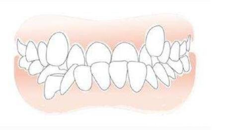校正牙齿的年龄，四种不同畸形类型最佳矫正年龄不同
