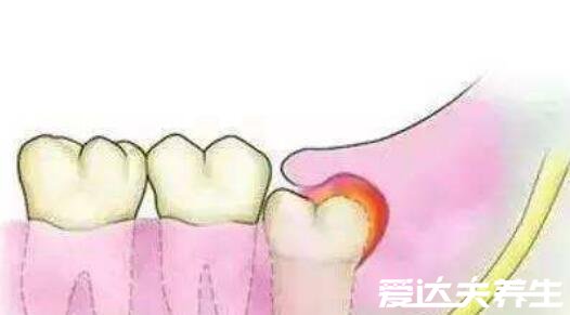 拔了智齿后悔终身，智齿不一定非拔不可