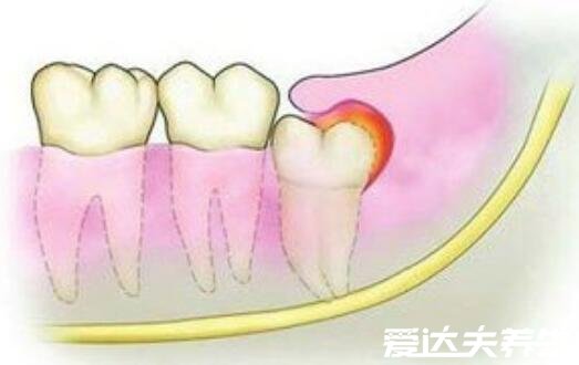 拔了智齿后悔死了，4种情况智齿不用拔(拔了必后悔)