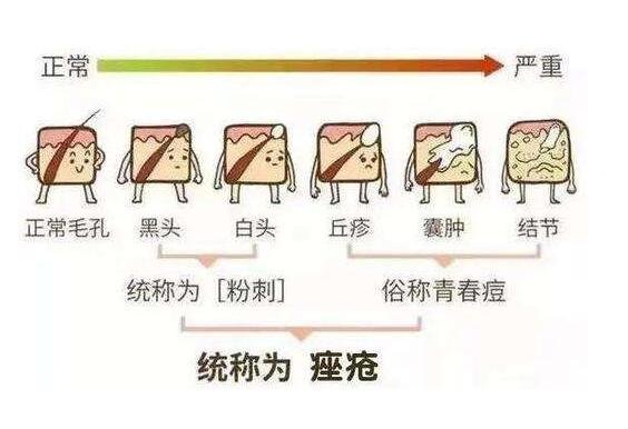 闭口是什么长什么样子图片，额头鼻翼两侧的突起白头(多发油性皮肤)