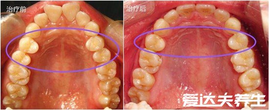 成年以后千万别整牙纯属误导，矫正牙齿随时行但确实需要多注意