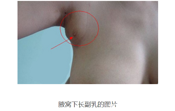 女人长副乳图片，教你怎么判断是副乳还是赘肉