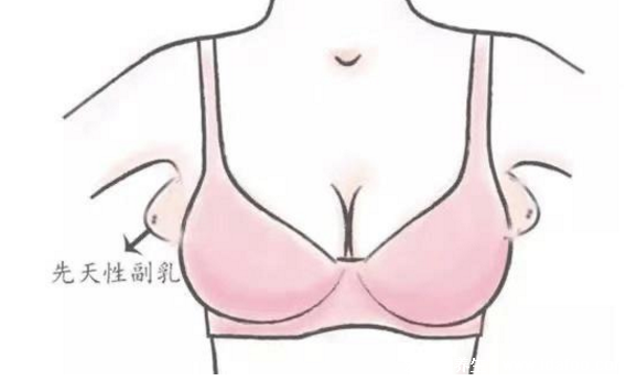 女人长副乳图片，教你怎么判断是副乳还是赘肉