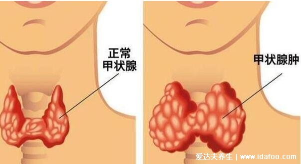 甲状腺最怕2个水果，榴莲/香蕉要慎吃加重甲状腺结节